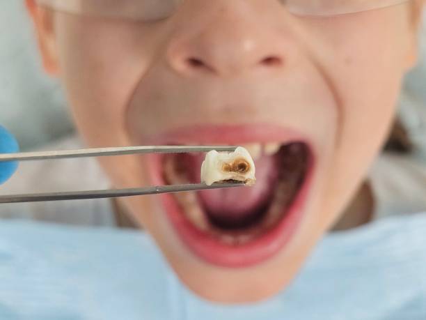 Best Emergency Dentist for Lost Fillings or Crowns in Passaic, NJ